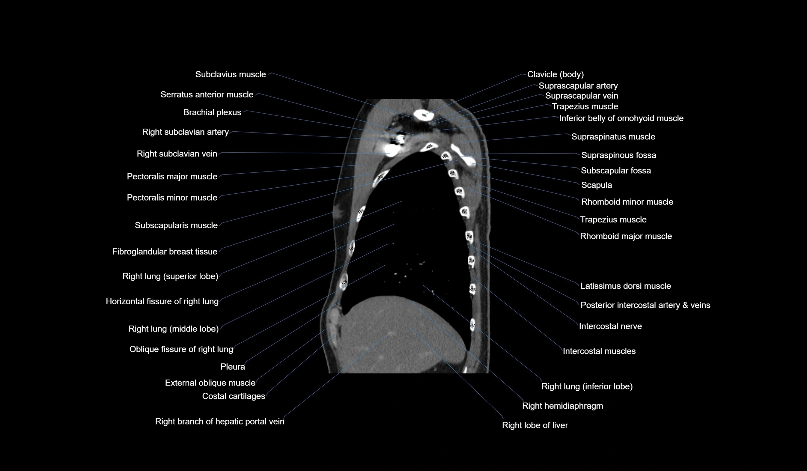 CT chest (thorax) labelled sagittal cross sectional anatomy radiology image-00033.webp